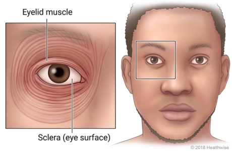 An eye, showing the muscles around it and the cornea, or eye surface