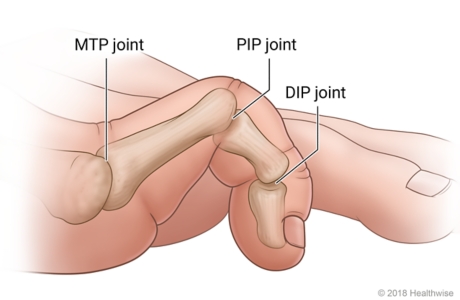 A claw toe showing the toe curled up