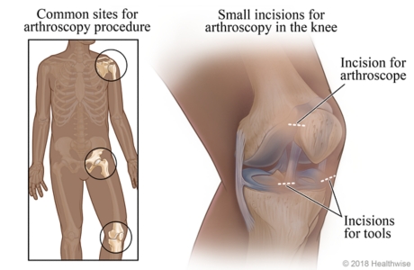 Common sites for arthroscopy, with detail of incision points in knee joint