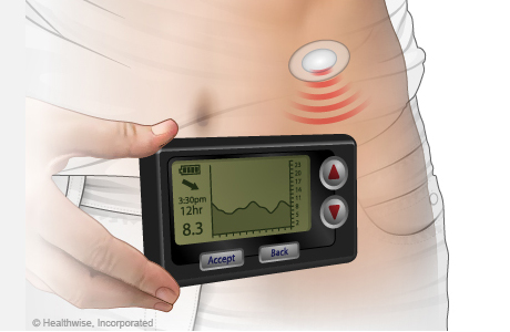 Continuous glucose monitor.