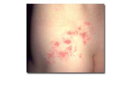 Shingles rash.