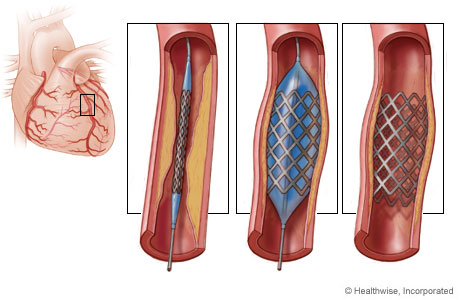 Coronary stent.