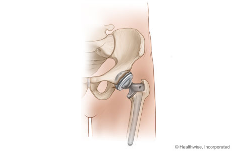 Completed hip replacement.