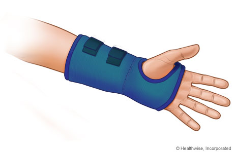 Wrist splint.