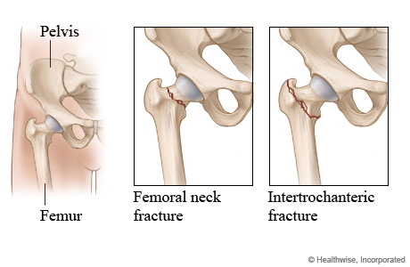 Two types of hip fracture.