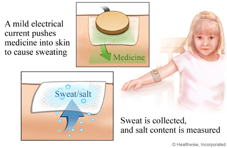 Picture of the sweat test procedure.