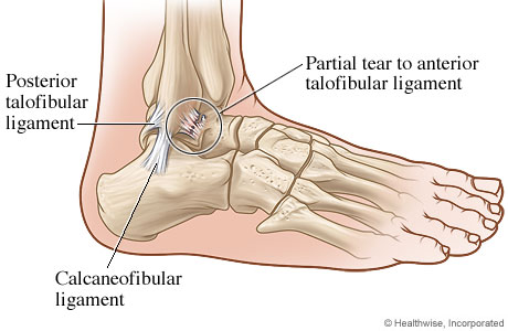 Ankle with a ligament tear.