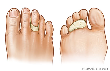 Toe crest pad as it appears on top of and under a toe.