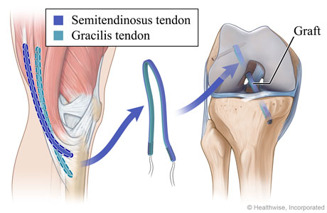 Hamstring graft for ACL surgery, showing the tendons used and the graft placed in the upper and lower leg bones