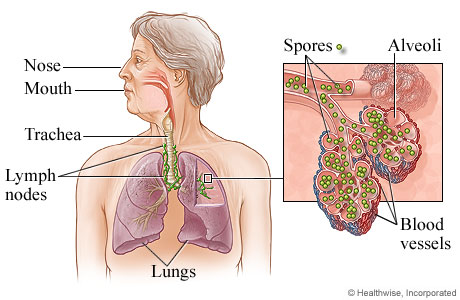 Picture of inhalational anthrax