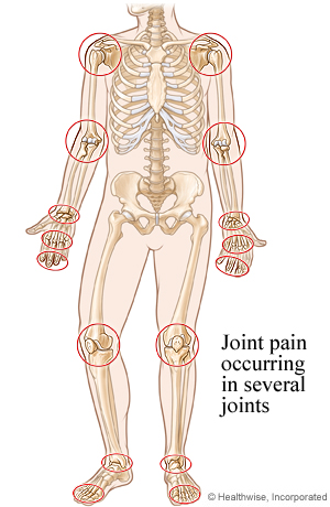 Picture of the common sites for rheumatoid arthritis