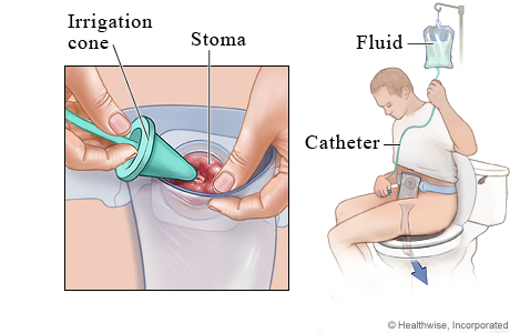 Colostomy irrigation