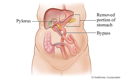 Biliopancreatic diversion with duodenal switch.