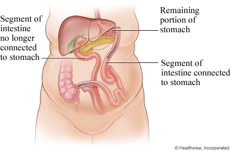 Biliopancreatic diversion.