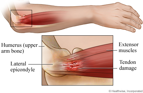 Tennis elbow anatomy: side view.