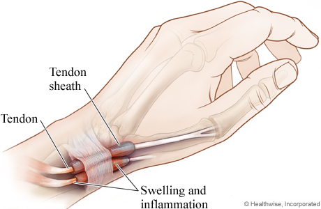 Tendon affected by de Quervain's disease.