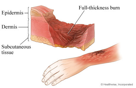 Third-degree burn: full-thickness burn.