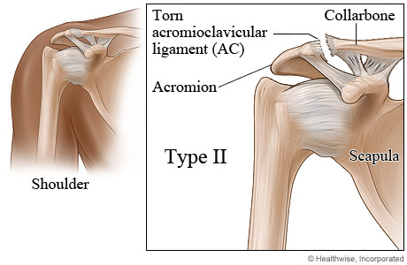 Type II shoulder separation.