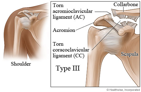 Type III shoulder separation.