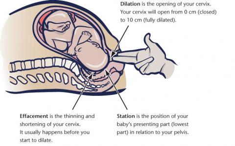 first stage of labour - dilation